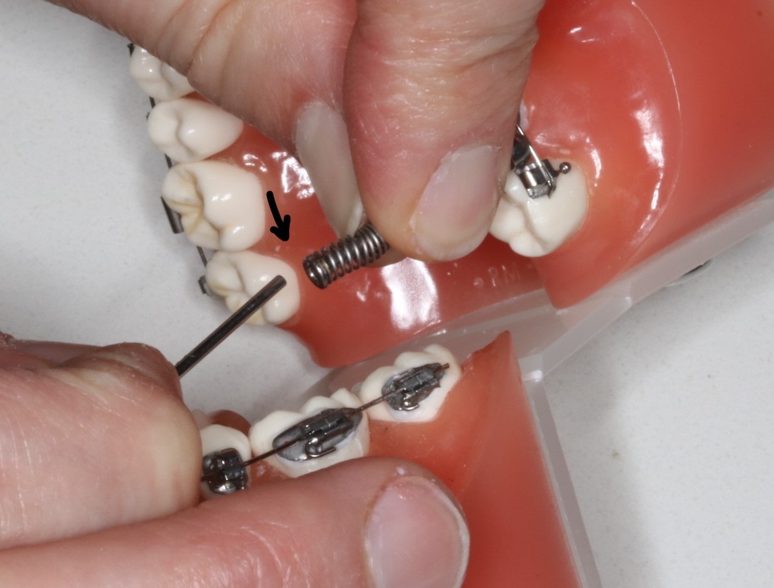 Réparation de tige métallique sortie du ressort dentaire.